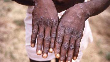 variole vers mpox